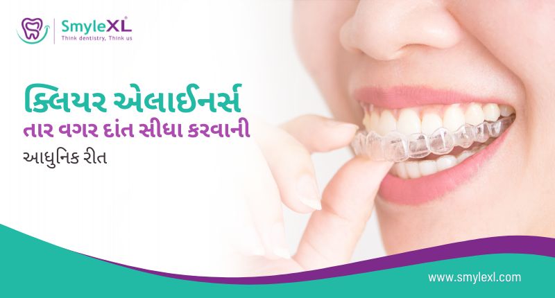તાર વગર દાંત સીધા કરવાની આધુનિક રીત: ક્લિયર એલાઈનર્સ