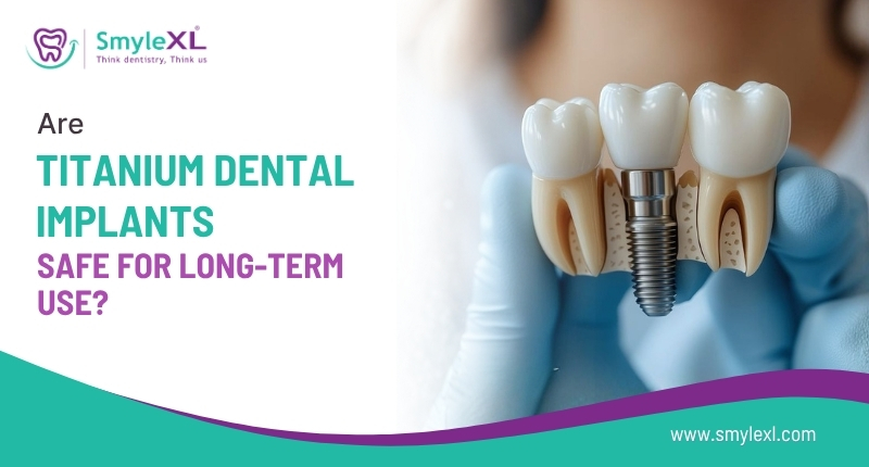 Are Titanium Dental Implants Safe for Long-Term Use?