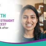 Are Teeth Perfectly Straight After Braces? Real Before & After