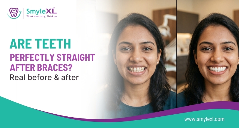 Are Teeth Perfectly Straight After Braces? Real Before & After