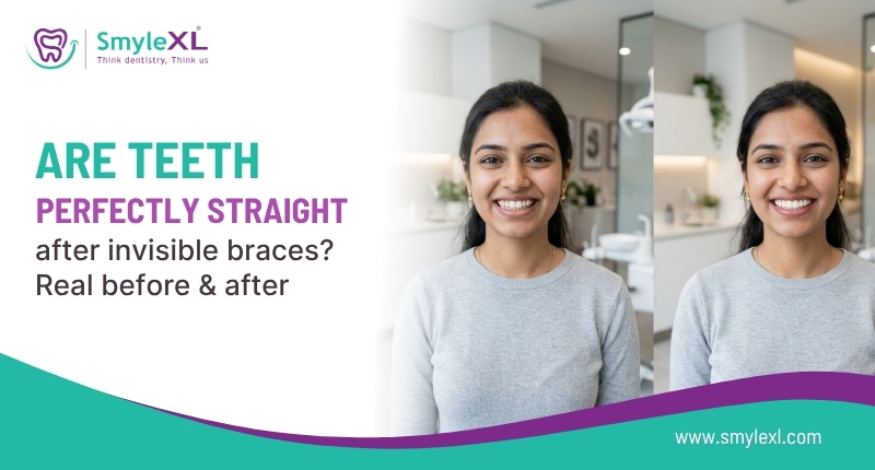 Are Teeth Perfectly Straight After Invisible Braces?