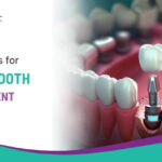 Best Options for Single Tooth Replacement