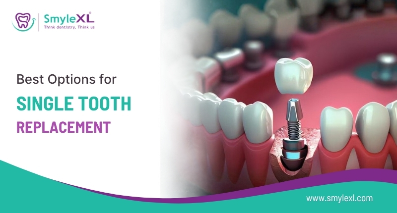 Best Options for Single Tooth Replacement