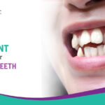 Dental Alignment Solutions for Crowded Teeth