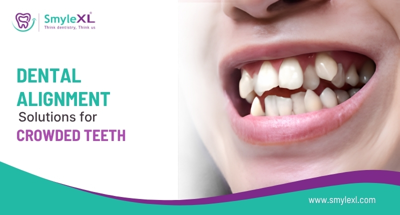 Dental Alignment Solutions for Crowded Teeth