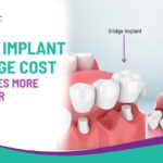 Dental Implant vs Bridge Cost – Which Saves More Money Over 10 Years?