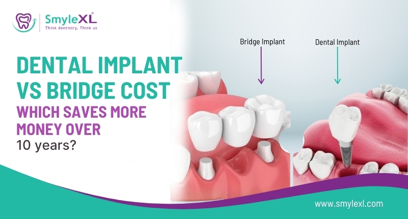 Dental Implant vs Bridge Cost – Which Saves More Money Over 10 Years?