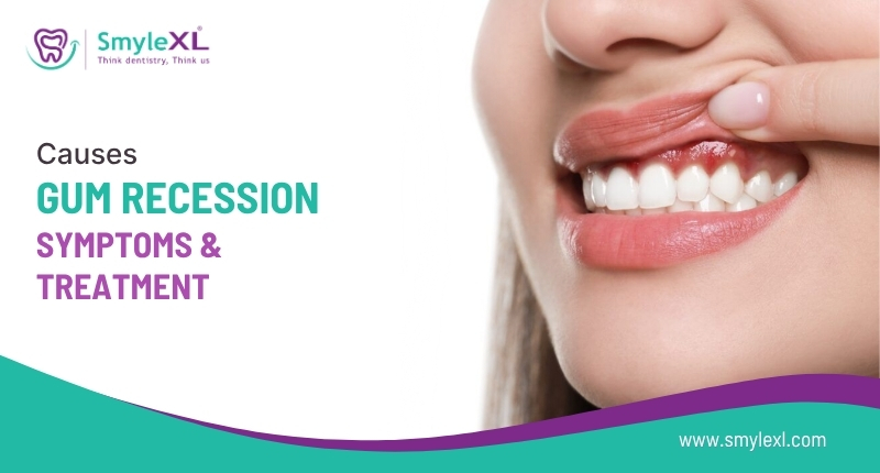 Gum Recession Causes, Symptoms, and Treatment