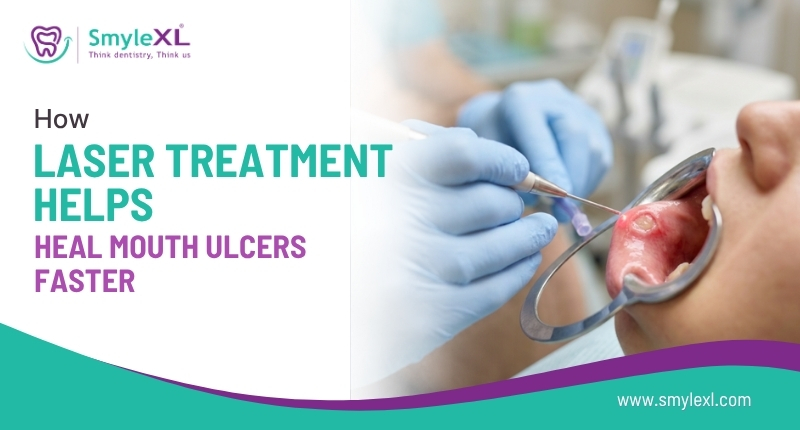 How Laser Treatment Helps Heal Mouth Ulcers Faster?