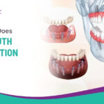 How Much Does Full Mouth Restoration Cost?