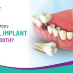 How Much Does a Dental Implant Cost Per Tooth?
