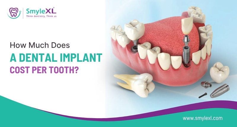 How Much Does a Dental Implant Cost Per Tooth?