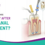 How Long Does a Tooth Last After Root Canal Treatment?