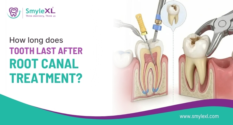 How Long Does a Tooth Last After Root Canal Treatment?