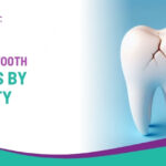How to Fix a Broken Tooth: Options by Severity
