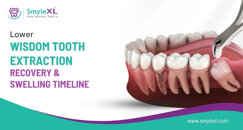 Lower Wisdom Tooth Extraction Recovery and Swelling Timeline