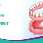 Permanent Teeth Replacement Without Dentures