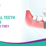 What Are Artificial Teeth Implants and How Do They Work?