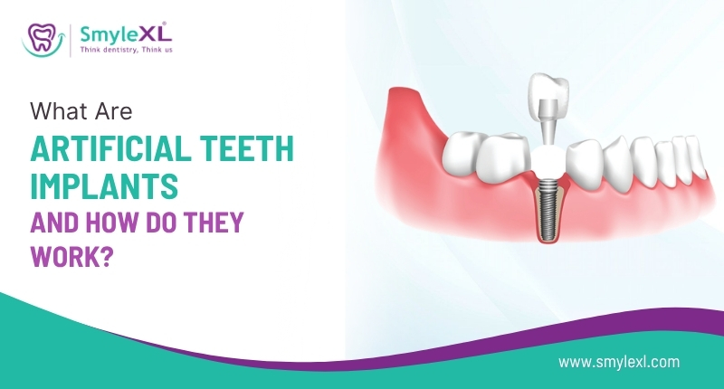 What Are Artificial Teeth Implants and How Do They Work?