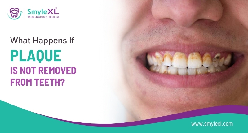 What Happens If Plaque Is Not Removed from Teeth?