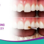 What Is Dental Bonding and How Long Does It Last?