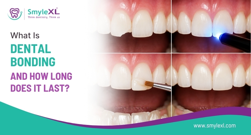 What Is Dental Bonding and How Long Does It Last?