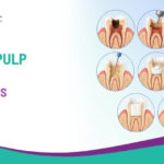 What Is Dental Pulp Therapy and When Is It Needed?