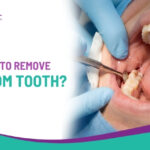 When Is the Right Time to Remove a Wisdom Tooth?