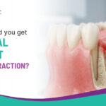 When Should You Get a Dental Implant After Extraction?