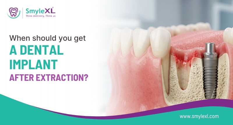 When Should You Get a Dental Implant After Extraction?