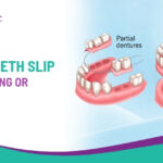 Why Do False Teeth Slip While Eating or Talking?