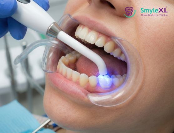 dental fillings treatment