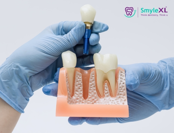 implant