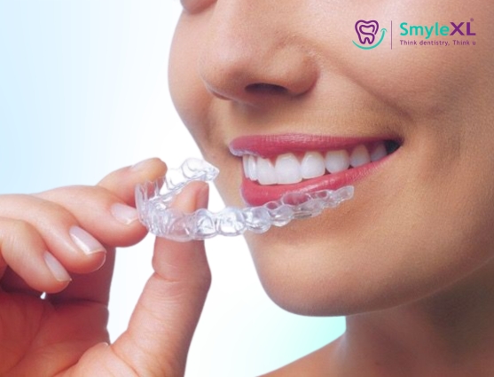 invisible braces treatment