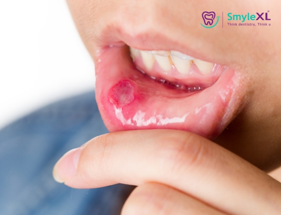 Mouth Ulcers in Salisbury Park