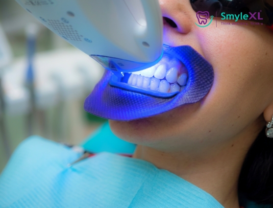 teeth whitening