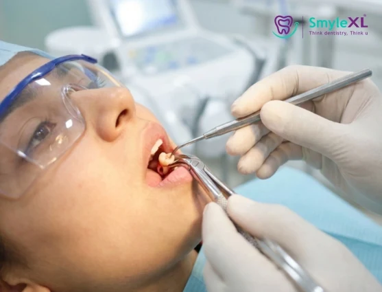 Wisdom Tooth Removal in Salisbury Park