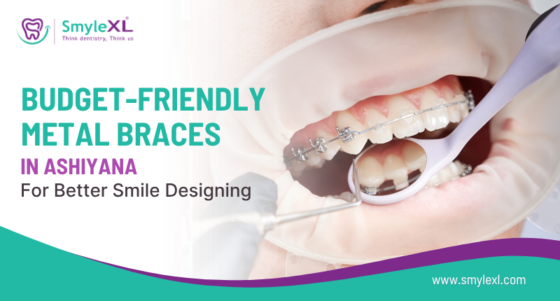 Budget-Friendly Metal Braces in Ashiyana for Better Smile Designing