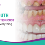 Full Mouth Rehabilitation Cost in Rahuri – Everything Included