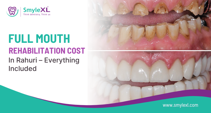 Full Mouth Rehabilitation Cost in Rahuri – Everything Included