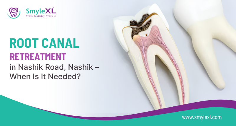 Root Canal Retreatment in Nashik Road, Nashik – When Is It Needed?
