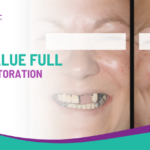 Best Value Full Mouth Restoration in Rahuri