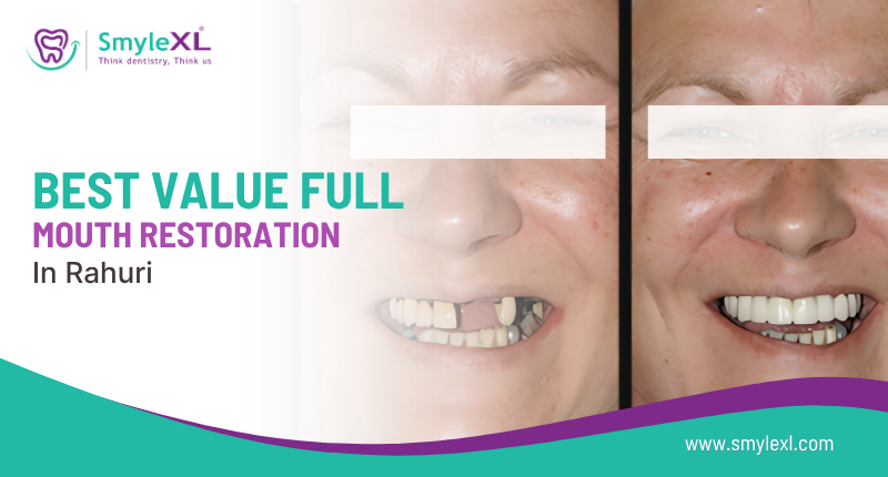 Best Value Full Mouth Restoration in Rahuri
