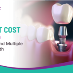 Dental Implant Cost in Kothrud for Single and Multiple Missing Teeth