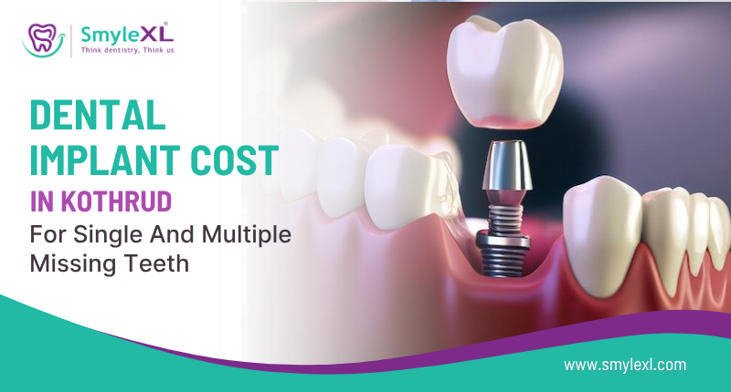 Dental Implant Cost in Kothrud for Single and Multiple Missing Teeth