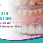Full Mouth Restoration in Viman Nagar with Personalized Treatment Plans