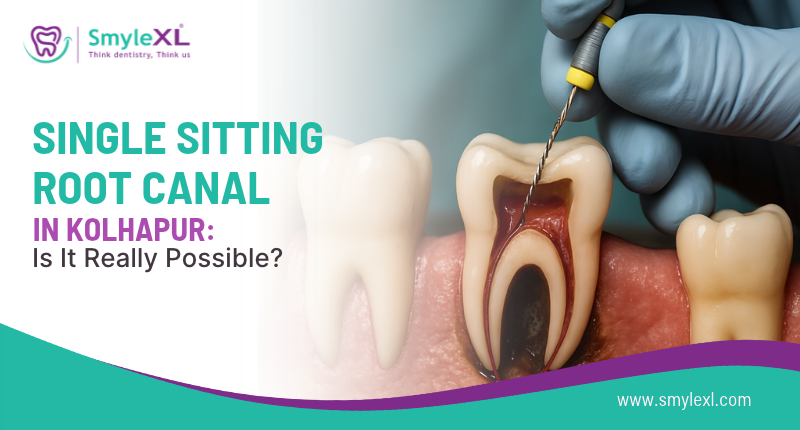 Single Sitting Root Canal in Kolhapur: Is It Really Possible?