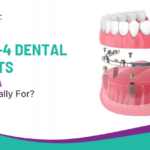 All-on-4 Dental Implants in Sanpada: Who Is It Really For?