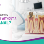 Can a Deep Cavity Be Treated Without a Root Canal?