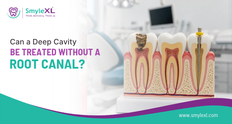 Can a Deep Cavity Be Treated Without a Root Canal?